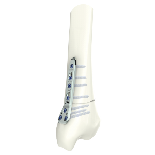 Distal Tibia Medial Plate – PediTST